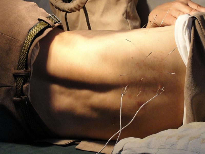 Akupunktur bei Lupus – Wirkt die Behandlung mit den Nadeln?