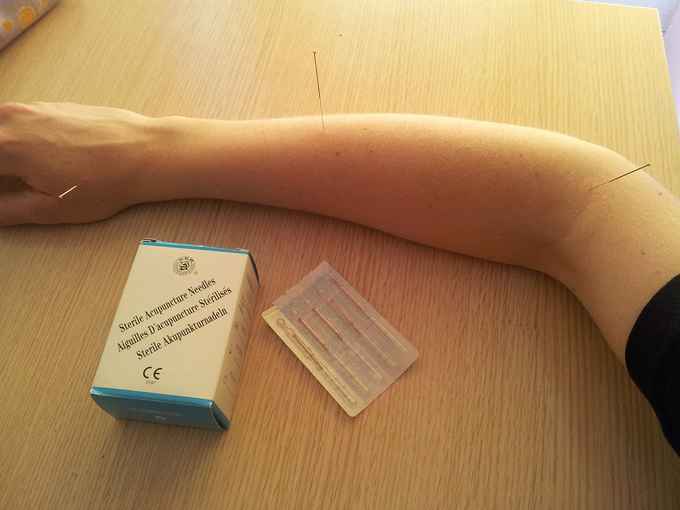 Akupunktur Vorteile – Was du wißen solltest!