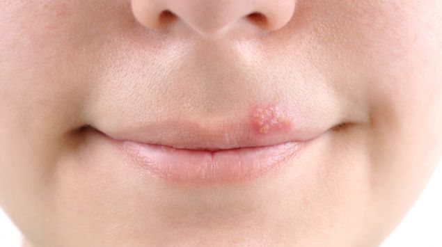 Natürliche Hausmittel gegen Herpes – so wirst du ihn los!