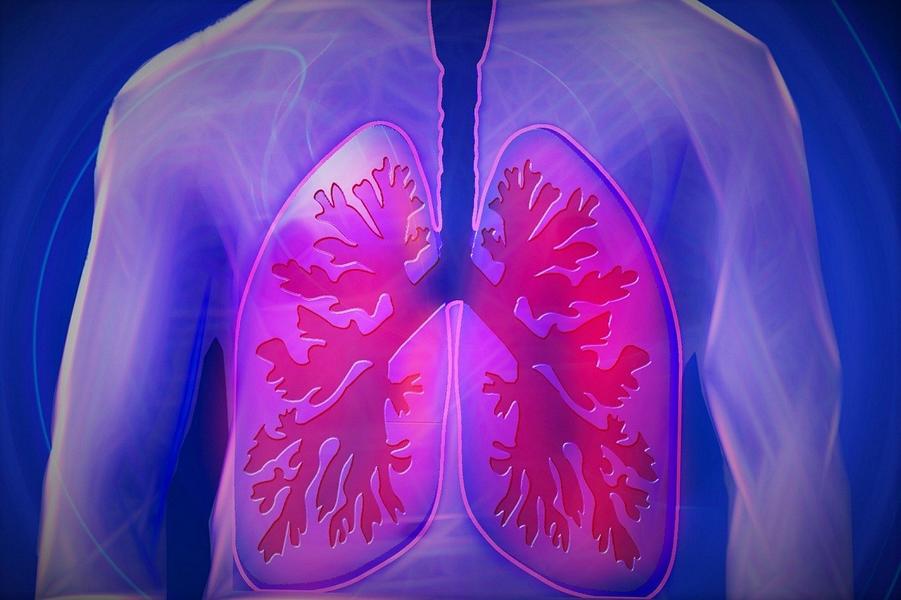 Lungenkrebs – Ursachen, Stadien, Lebenserwartung und mehr!