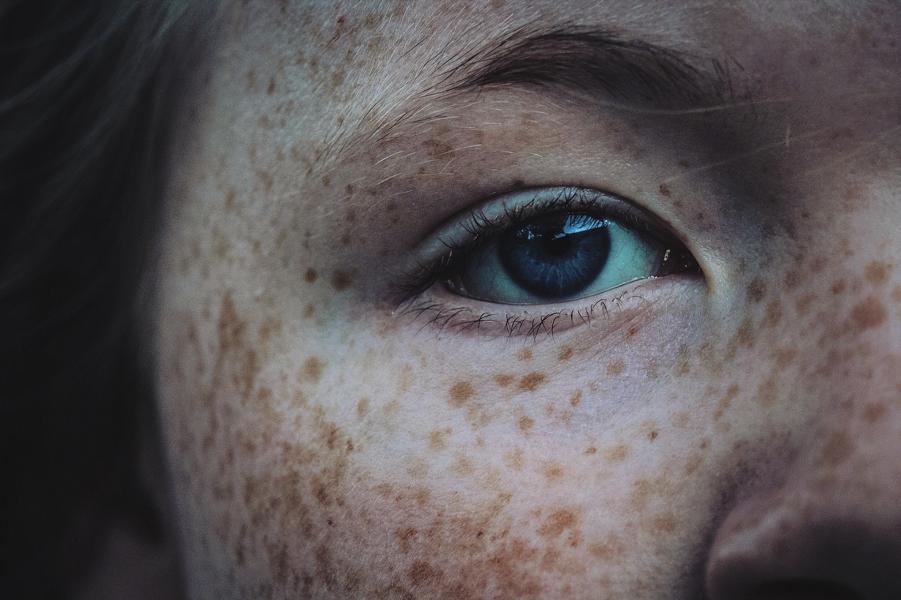 Pigmentflecken im Gesicht – Symptome, Ursachen und Behandlung