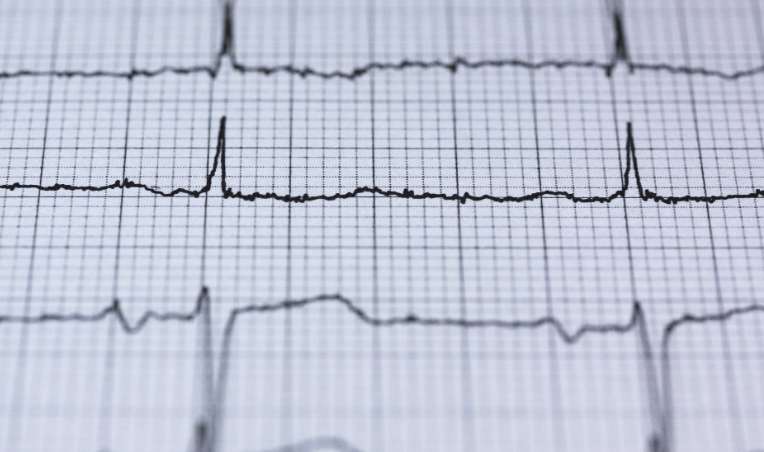 Vorhofflimmern – Symptome, Ursachen und Behandlung