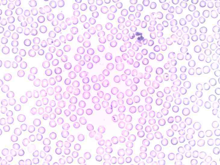 Zu viele weiße Blutkörperchen – Symptome und Ursachen