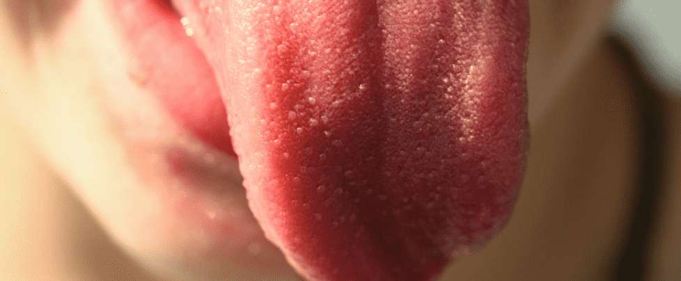 Zunge verbrannt – was tun? Ursachen und Behandlungen!